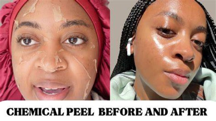 best face peel