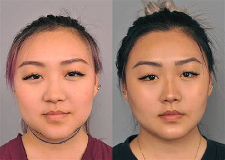 buccal fat removal
