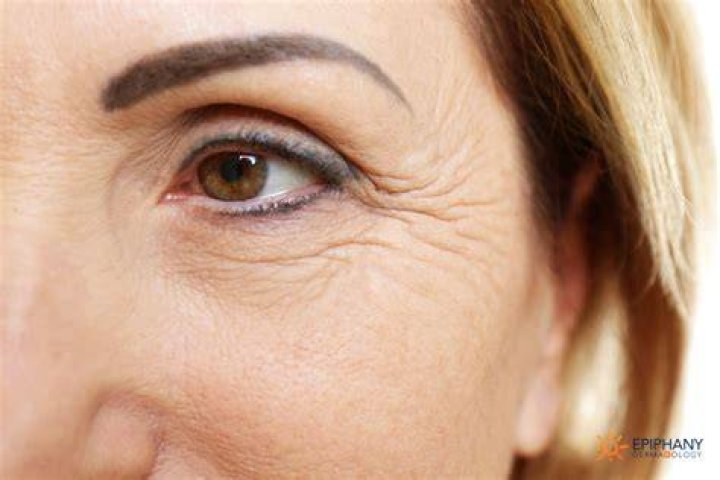 eye wrinkles