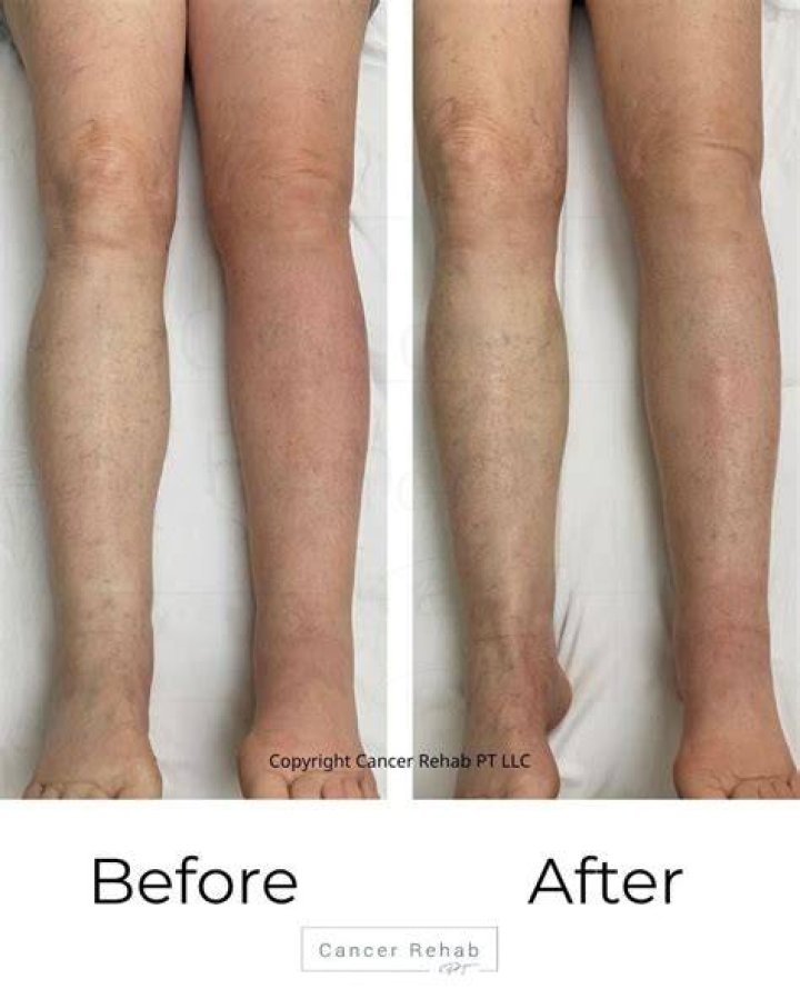 lymphatic drainage legs before and after