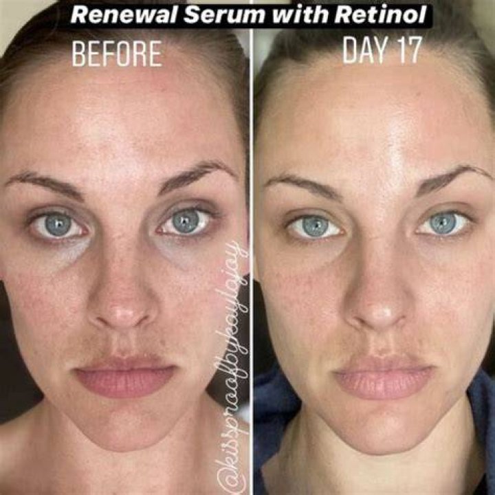 retinol before and after