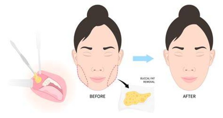 suitable for buccal fat removal